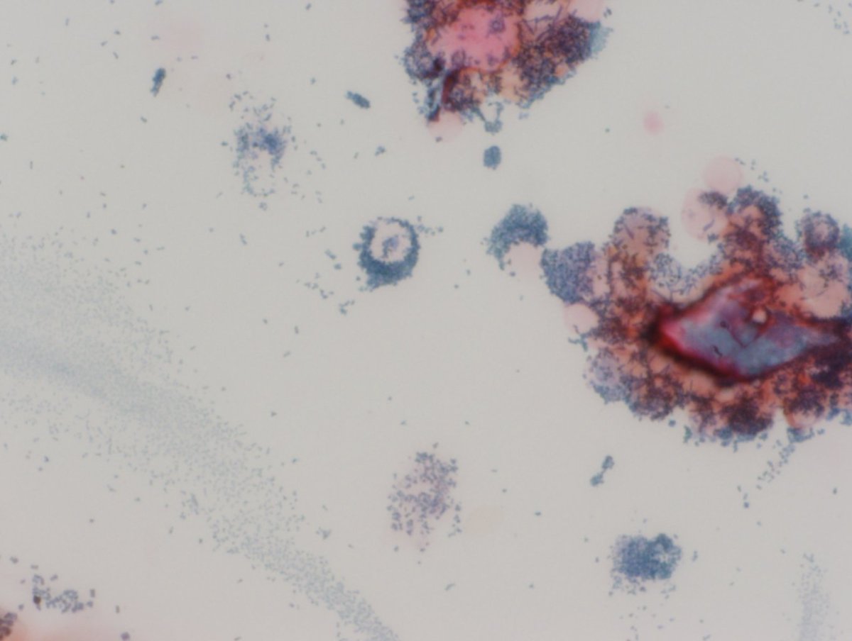 Myeloperoxidase cytochemical stain showing strong positive staining in the immature cells.